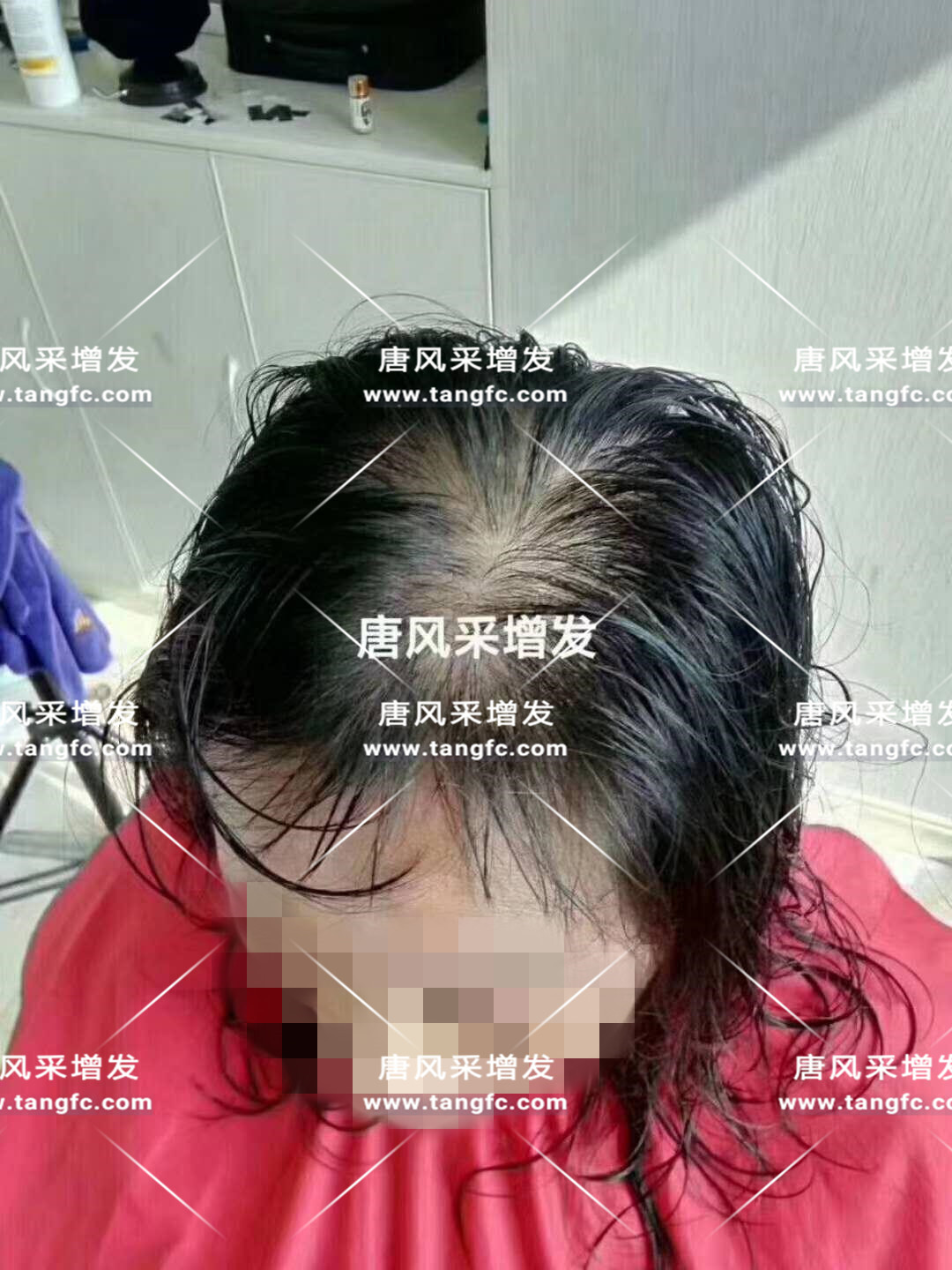 謝頂會坑一輩子？ 我不禁摸了摸自己頭發(fā)