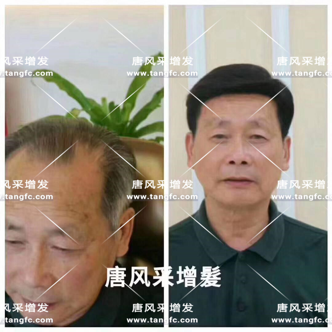 謝頂會坑一輩子？ 我不禁摸了摸自己頭發(fā)