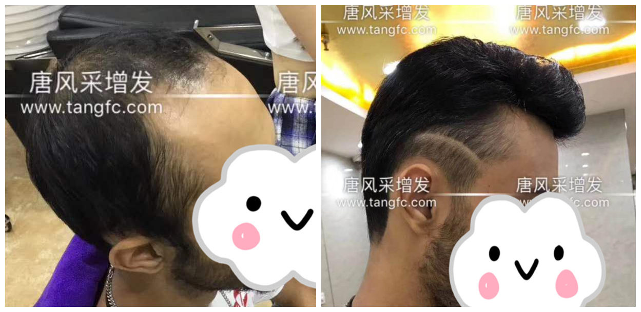 男士假發(fā)容易看出來(lái)嗎？看看做過(guò)頭發(fā)的發(fā)友怎么說(shuō)！