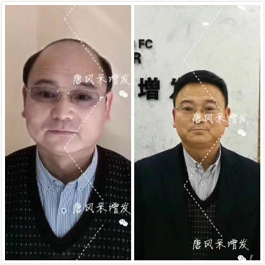 如何避免成為一個(gè)脫發(fā)的中年猥瑣男人？